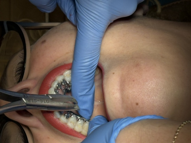 Cool Smilez patient transformation