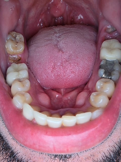 Cool Smilez smile makeover
