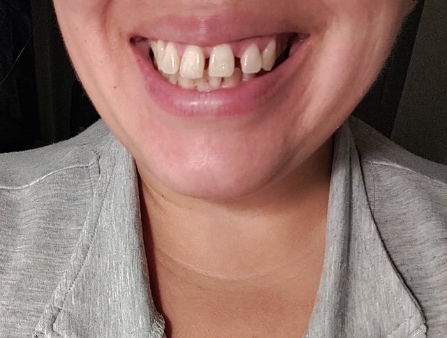 Cool Smilez braces result
